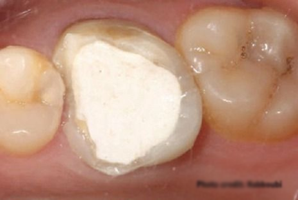 Temporary Fillings