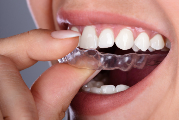 Mouth Gaurds