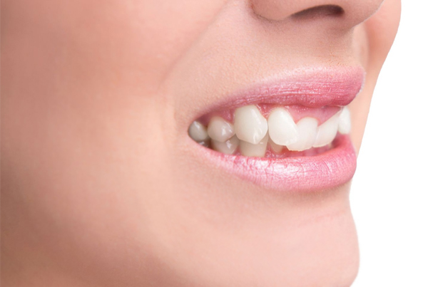 Teeth Reshaping