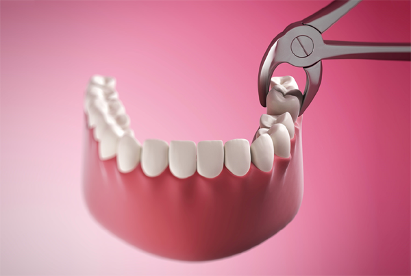 Painless Extraction