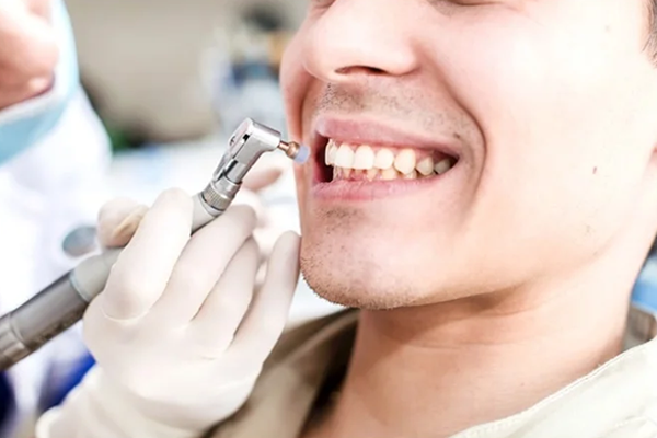 Teeth Polishing