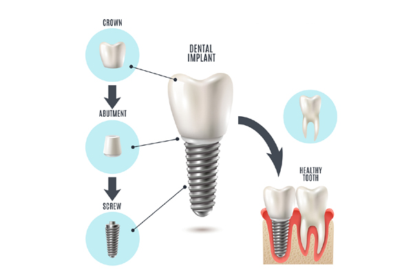 Implant Surgery