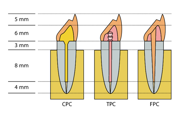 Post and Core