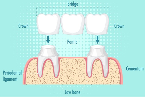 Fix Crown and Bridges