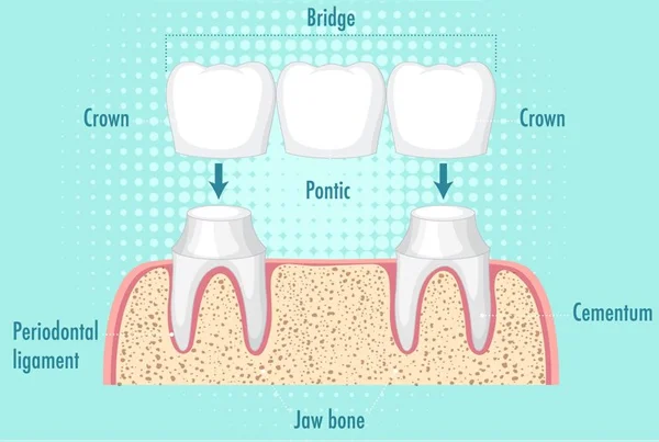 Fix Crown and Bridges