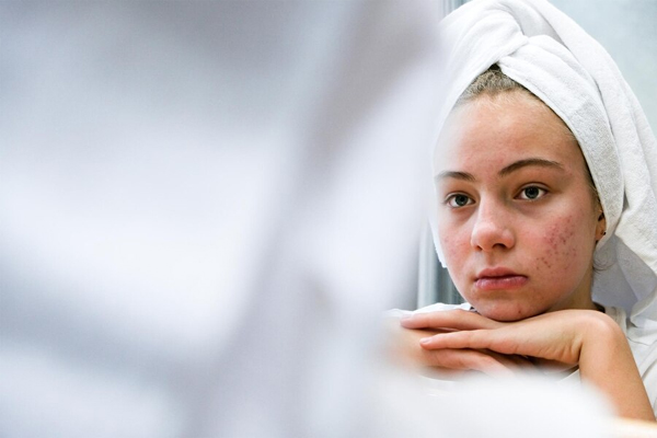 Acne Scar Treatment